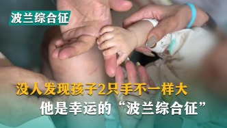 没人发现孩子2只手不一样大，他是幸运的“波兰综合征”