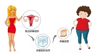 卵巢冻存的那些事